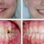 Фото до и после лечения