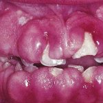 фото гингивита