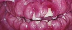 photo of gingivitis