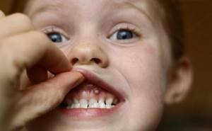 Фото кисты десны зуба у ребенка