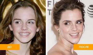 Фото кривых зубов Эммы Уотсон до и после лечения
