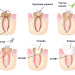 Photo of root canal treatment