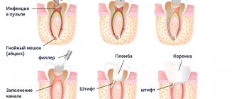 Фото лечения каналов зуба