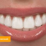 Photo of orthognathic bite