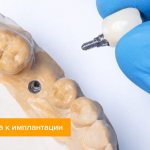 Фото подготовки к установке импланта зуба на модели