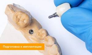 Фото подготовки к установке импланта зуба на модели