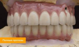 Фото полных зубных протезов на имплантах