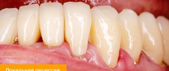 Photo of gum recession