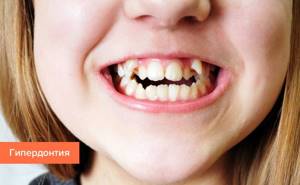 Фото сверхкомплектных зубов (гипердонтии) у ребенка