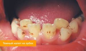 Фото темного налета на детских зубах