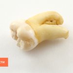 Фото зуба мудрости