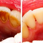 Фото зубов до и после чистки у стоматолога