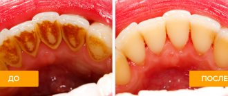 Фото зубов до и после чистки у стоматолога