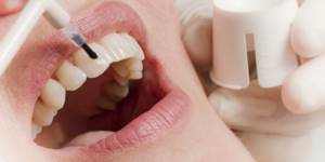 фторирование зубов