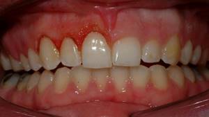 Гингивэктомия лазером в области одного зуба