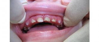 гипоплазия эмали зуба