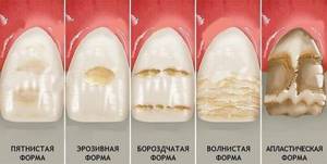 гипоплазия эмали зуба