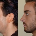 Глубокий дистальный прикус