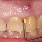 гной под десной