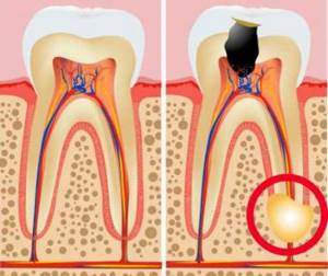гранулематозное образование на корне зуба