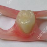 Иммедиат-протез «бабочка»