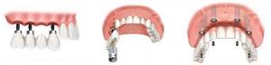 Имплантация передних, жевательных зубов и полной верхней челюсти