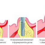 Имплантация при атрофии костной ткани проходит в несколько этапов. После вживления костного материала происходит установка импланта. В начале формируется ложе под искусственный корень. Затем устанавливается имплант и формирователь десны. На конечном этапе устанавливается абатмен на место формирователя и коронка.