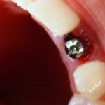 Имплантация зуба