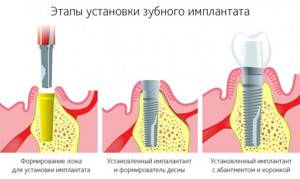 Имплантация зубов - основные этапы