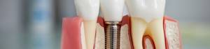 Имплантированный зуб