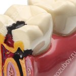 Индекс КПУ при кариесе