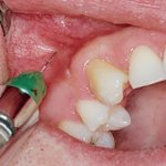 Инфильтрационная анестезия в стоматологии
