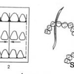 Selective grinding of the enamel of individual teeth