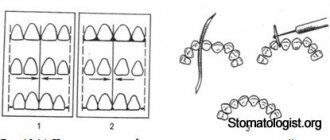 Selective grinding of the enamel of individual teeth