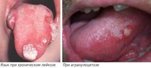 Изменения языка при хроническом лейкозе и агранулоцитозе