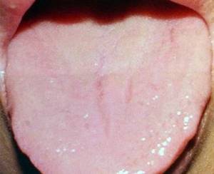 Изменения языка при железодефицитной анемии