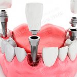 Качество зубных имплантов