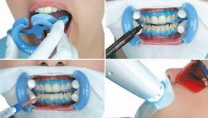 Как делается отбеливание зубов системой Beyond Polus