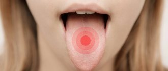 Как избавиться от боли в языке?