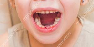 Как остановить кровь при выбитом зубе у ребенка