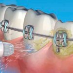 How to use a irrigator to clean braces