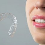 Как происходит выравнивание зубов элайнерами