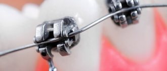 How do vestibular and lingual braces work?