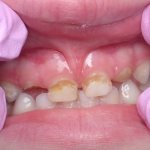 Какими могут быть причины повреждений молочных зубов