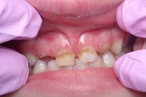 Какими могут быть причины повреждений молочных зубов