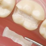 какую пломбу лучше ставить на жевательные зубы взрослым