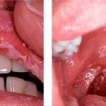 Oral candidiasis, photo 1