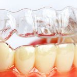 Капы после брекетов