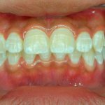 Кариес в стадии белого пятна