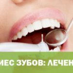 Кариес зубов: лечение в домашних условиях
